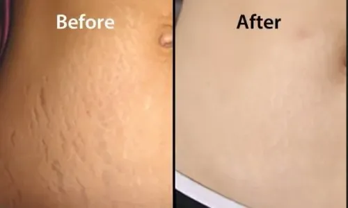 Laser Stretch Mark Removal  service image