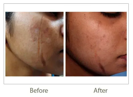 Co2 fractional laser treatment  service image