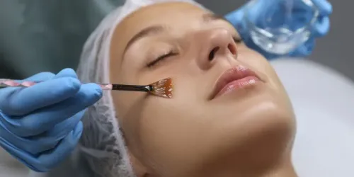 Chemical peeling  service image