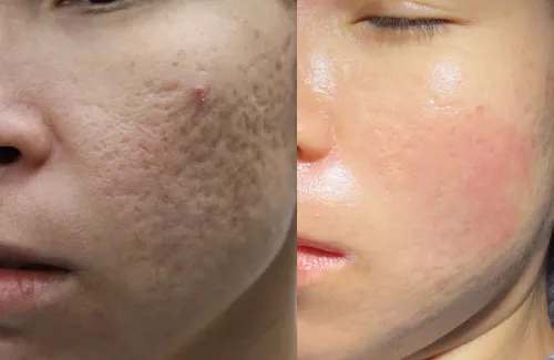 Acne scar removal service image