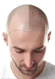 Scalp micropigmentation service image