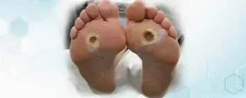 Ulcer Healing Surgery service image