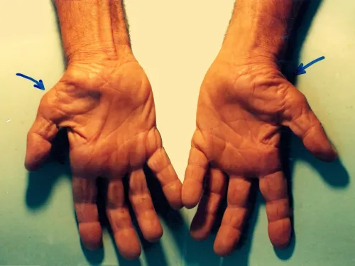 Carpal Tunnel Disorder service image