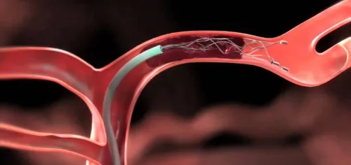Stroke and Mechanical Thrombectomy service image