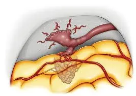 AVM and Dural Fistulas service image