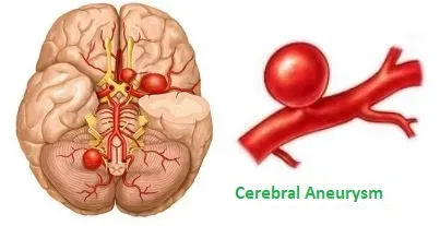 Neurovascular Disorder Like Aneurysm service image