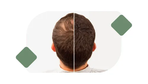 Hair Transplantation service image