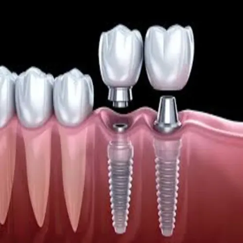 Dental Implants service image