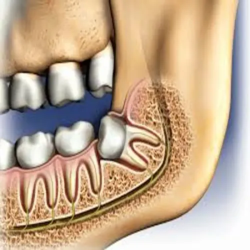 Wisdom Tooth Removal service image