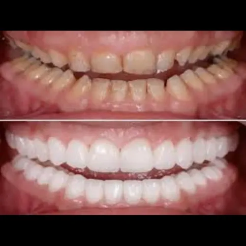 Full Mouth Rehabilitation service image