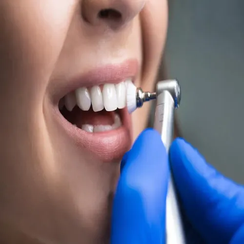 Dental Cleaning & Polishing service image
