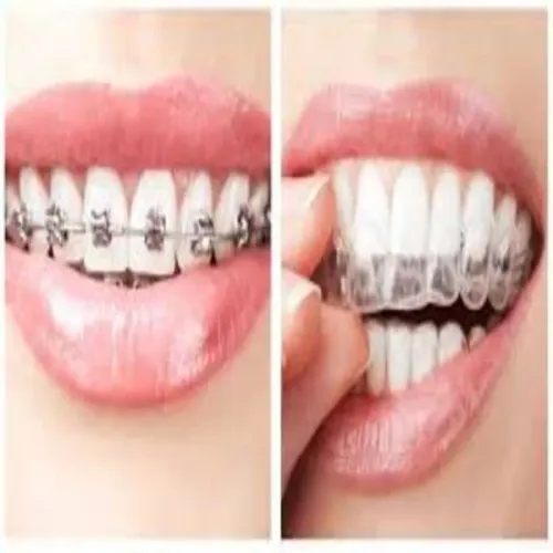 Braces & Aligners service image