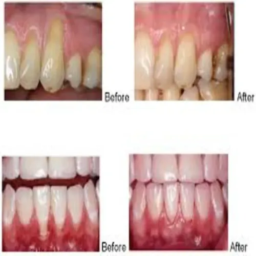 Periodontal Surgery service image