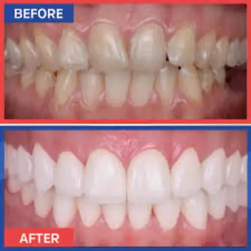 Hollywood Smile Design service image