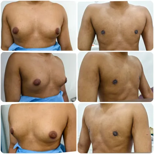 Gynaecomastia correction service image
