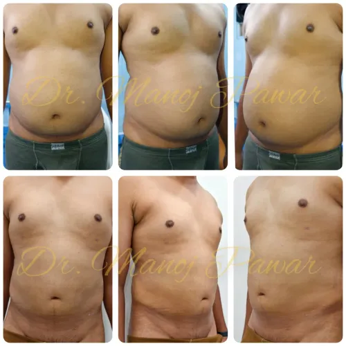 Liposuction service image