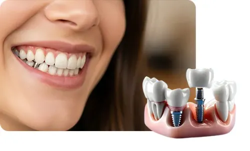 Dental Implants service image