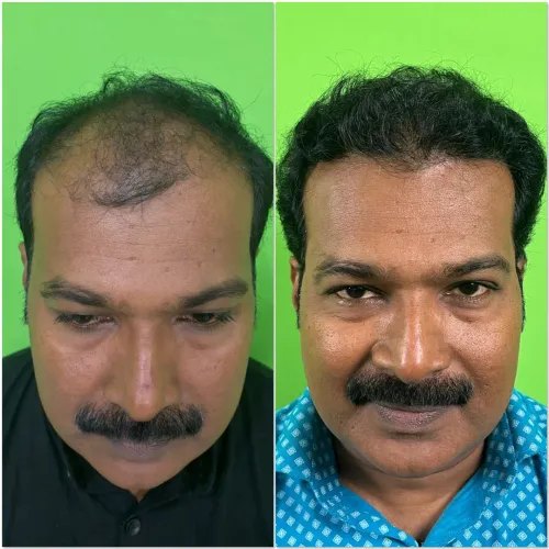 ADVANCE HAIR TRANSPLANT SURGERY service image