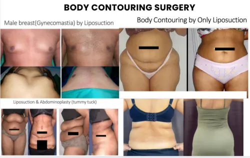 BODY CONTOURING SURGERIES service image