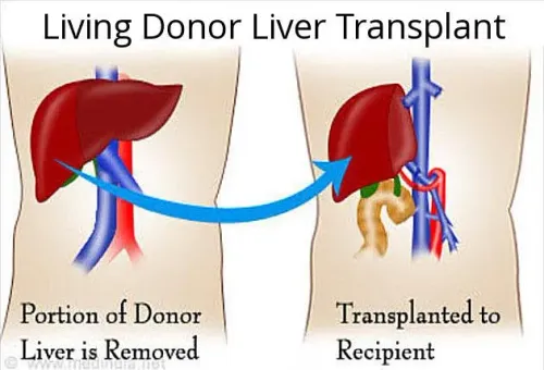 LIVING DONOR LIVER TRANSPLANT service image