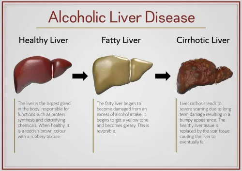 ALCOHOLIC LIVER DISEASES MANAGEMENT service image