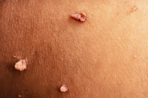 Warts service image
