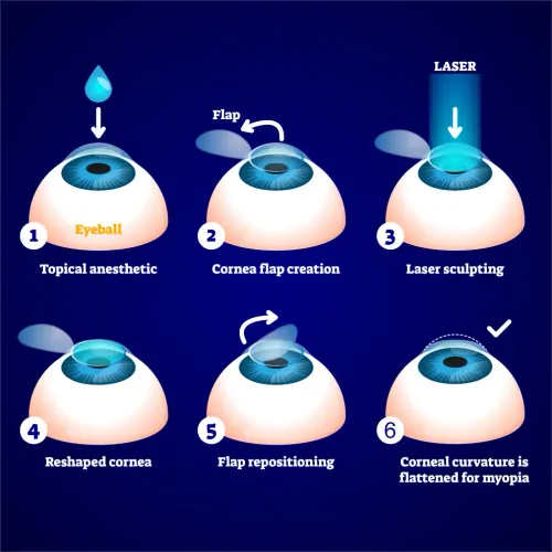 LASIK Eye Surgery in Zirakpur | Vision Correction service image