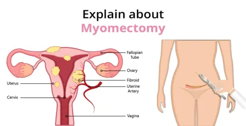 Myomectomy (Fibroids) Treatment service image