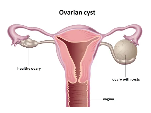 Ovarian Cyst Surgery service image