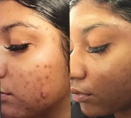 CHEMICAL PEEL service image