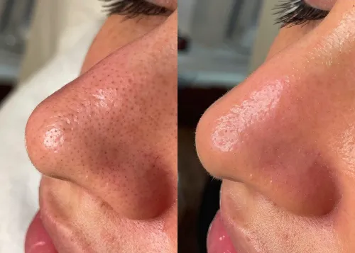 HYDRAFACIAL service image