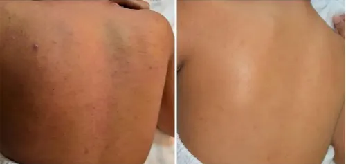 Chemical peel service image