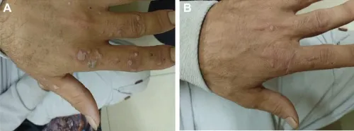 IMMUNOTHERAPY FOR WARTS service image