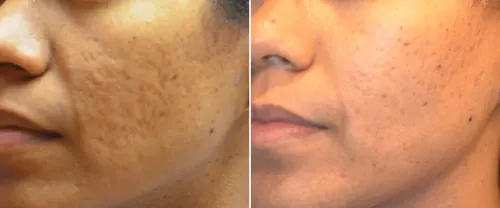 Microneedling service image