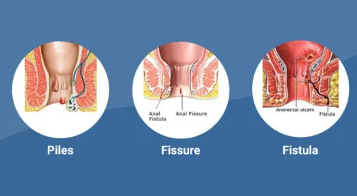 Piles/Fissure/Fistula service image