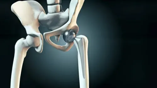 Primary Hip and Knee Arthroplasty service image