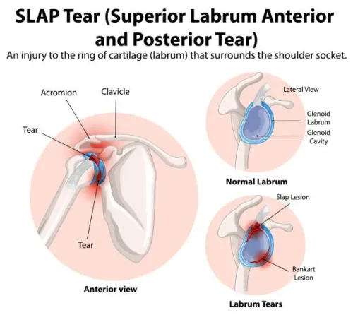 Shoulder SLAP (Tear) Lesions service image