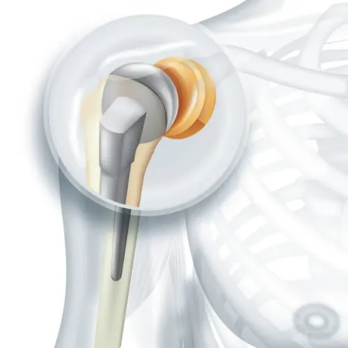 Shoulder Replacement service image