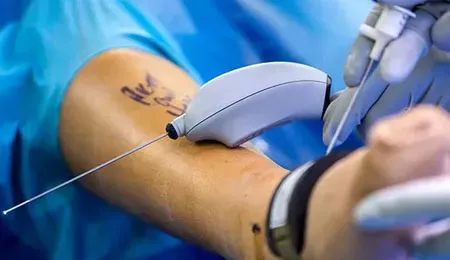 Joint Replacement Surgeries service image