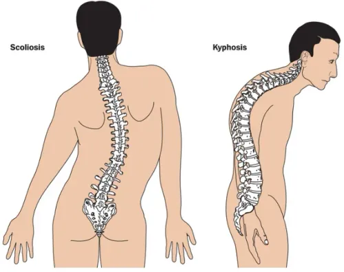 Kyphosis, Scoliosis & Occipito-Cervical Fusion Surgery service image