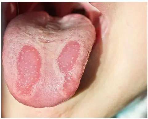 Burning Mouth Syndrome Treatment service image