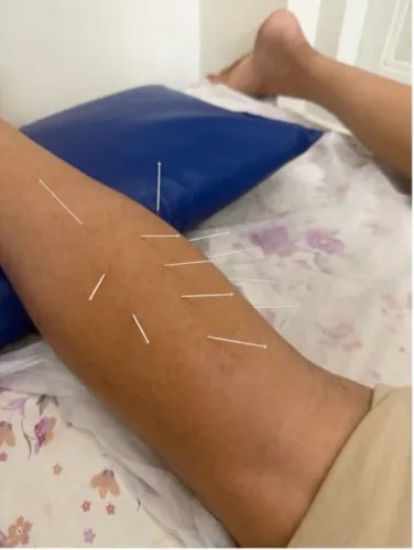 Dry Needling  service image
