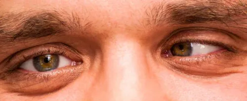 Squint Treatment in Thane service image