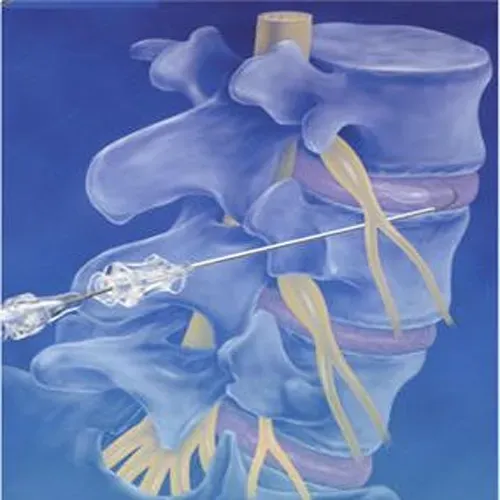 Epidural Neurolysis Treatment service image