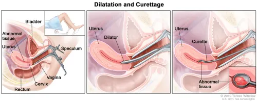  Dilation and Curettage service image