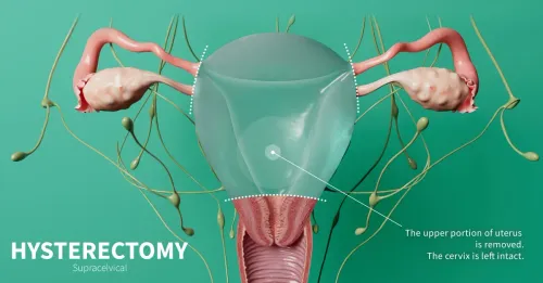 Hysterectomy service image