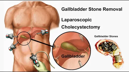Gall Bladder Stone Surgery  service image