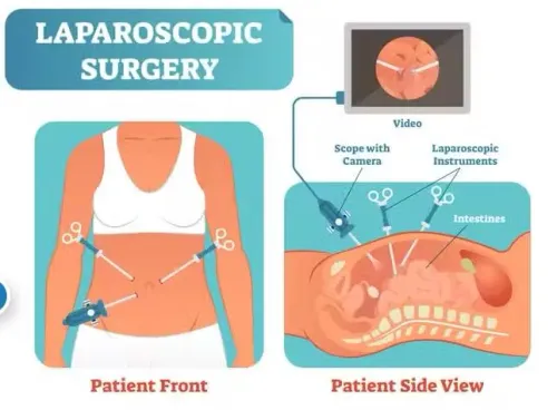 All Type of laparoscopic surgery service image
