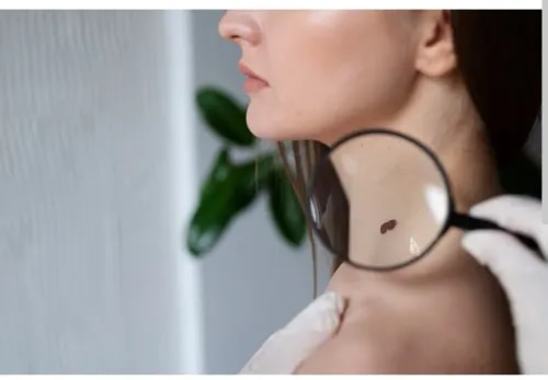 Skin Tag Removal
service image