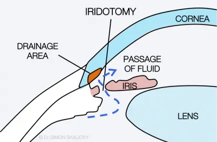YAG LASER Peripheral Iridotomy in Thane service image